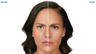 HMC - Weight Loss Center - BOTOX Cosmetic - Before and After